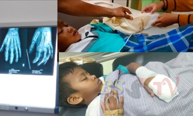 
 Hasil Rontgen RSUD Abdul Rivai Bagus, Ridwan Diizinkan Pulang Hari Ini Usai Insiden Mesin Molen